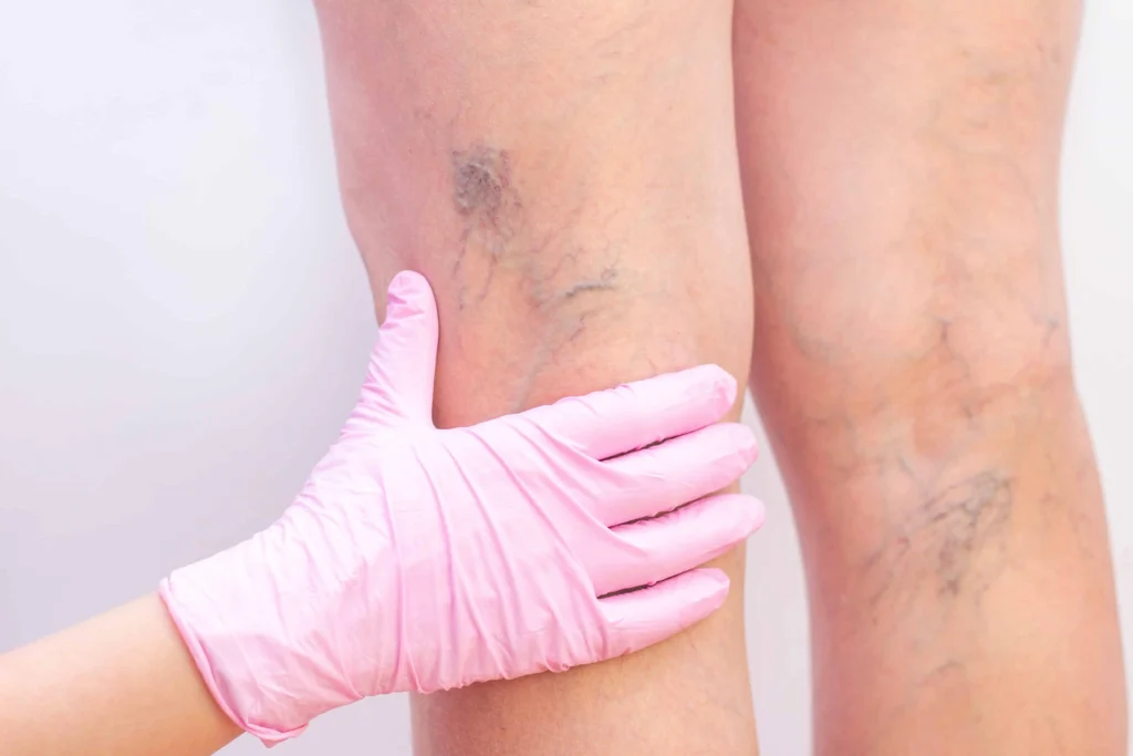 Vascular Lesions