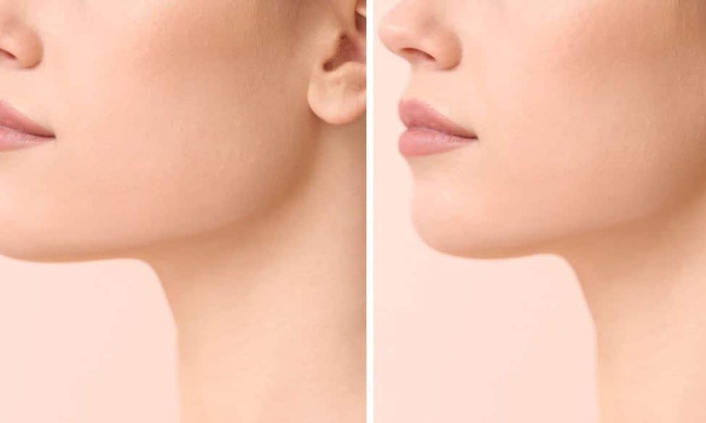 Chin enhancement, Bio-stimulator or Hyaluronic Acid before & after | Glow MedSpa Of 30