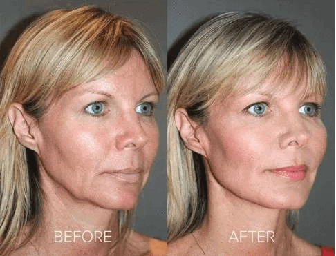 Is a PDO Threadlift For Me? 7 Pdo-threadlift Before And After Treatment photos in Santa Rosa Beach FL | Glow MedSpa Of 30A