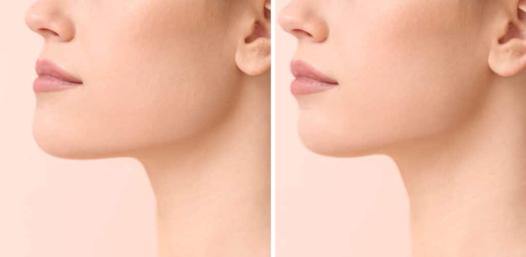 Chin enhancement, Bio-stimulator or Hyaluronic Acid before & after | Glow MedSpa Of 30