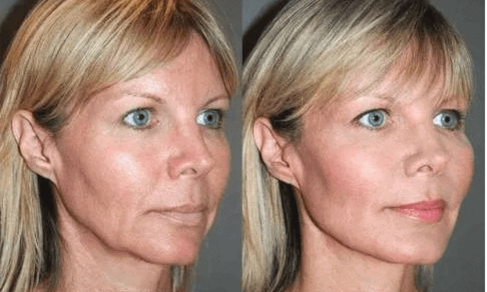 Pdo-threadlift Before And After Treatment photos in Santa Rosa Beach FL | Glow MedSpa Of 30A